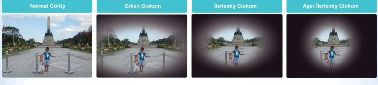 Glokomda erken tanı kör olmayı önlüyor - 3