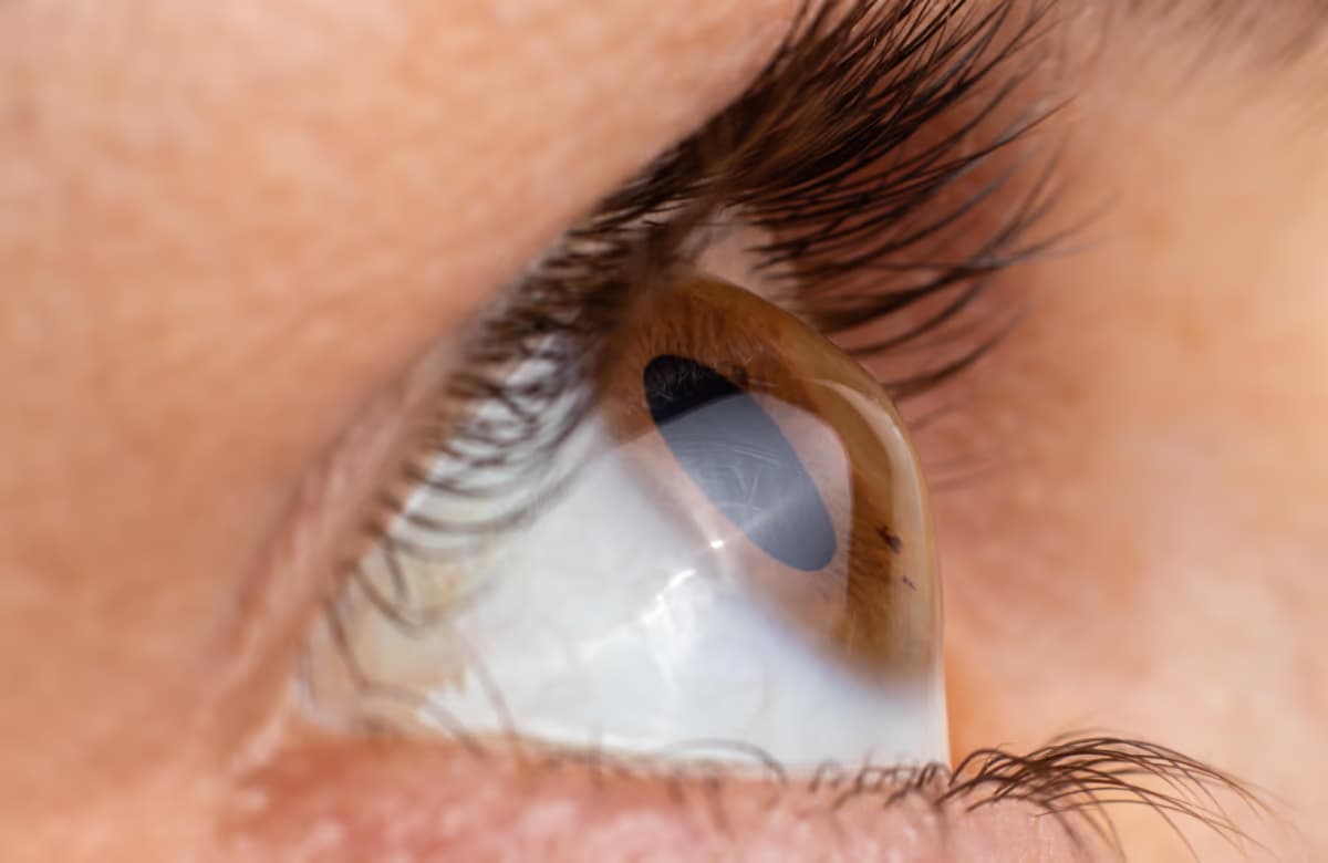 Diese Erkrankung führt zur Hornhauttransplantation