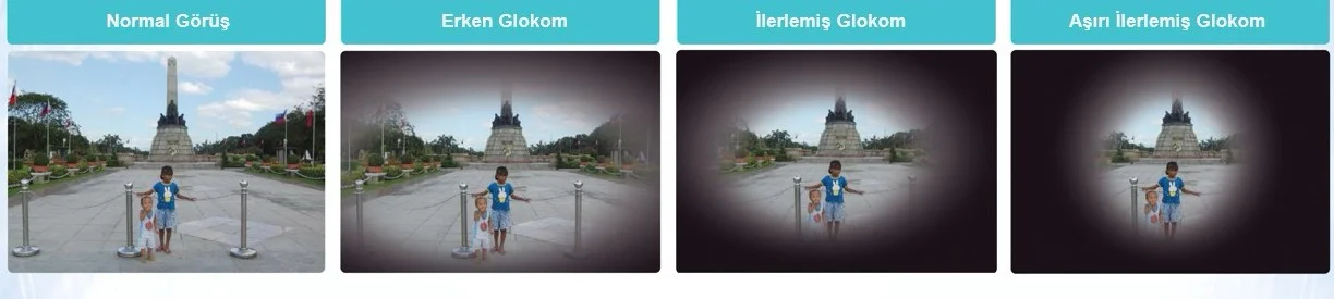 Glokomda erken tanı kör olmayı önlüyor - 3